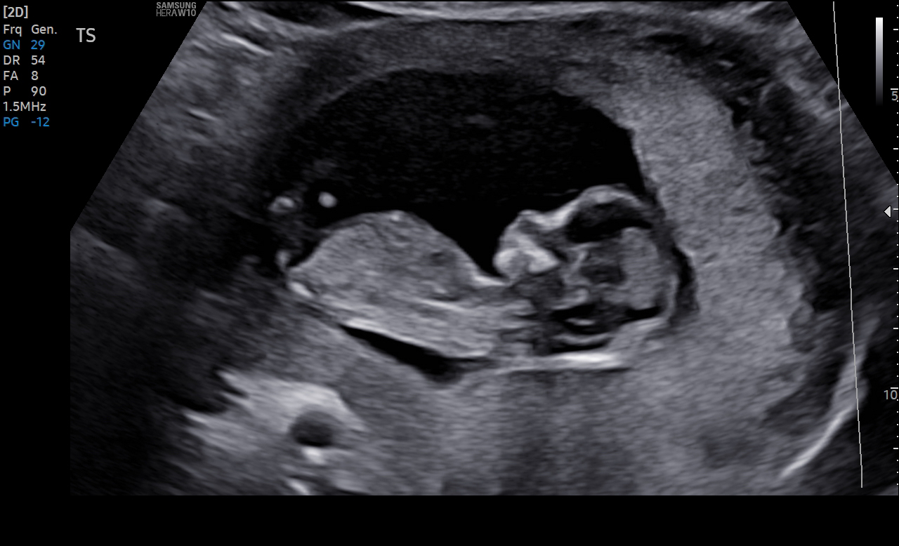 pregnancy confirmation via ultrasound